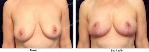 Treo ngực sa trễ không đặt túi, nữ 53 tuổi - ca 44