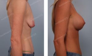 Treo ngực sa trễ kết hợp đặt túi Mentor ở bệnh nhân teo tuyến và chảy xệ nặng, nữ 30 tuổi - ca 5