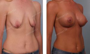 Treo ngực sa trễ kết hợp đặt túi Mentor ở bệnh nhân teo tuyến và chảy xệ nặng, nữ 30 tuổi - ca 5