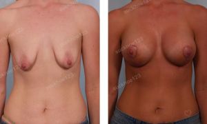 Treo ngực sa trễ kết hợp đặt túi Mentor ở bệnh nhân teo tuyến và chảy xệ nặng, nữ 30 tuổi - ca 5