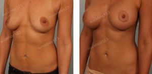 Treo ngực sa trễ kết hợp đặt túi gel đường quầng vú, nữ 34 tuổi - ca 6