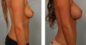 Treo ngực sa trễ kết hợp đặt túi gel đường quầng vú, nữ 34 tuổi - ca 6