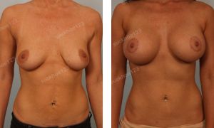 Treo ngực sa trễ kết hợp đặt túi gel đường quầng vú, nữ 34 tuổi - ca 6