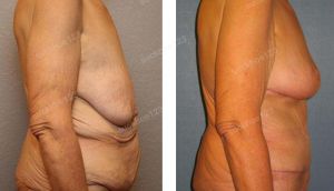 Combo treo ngực sa trễ không đặt túi & tạo hình thành bụng, nữ 60 tuổi nhiều da chùng sau giảm cân - ca 39