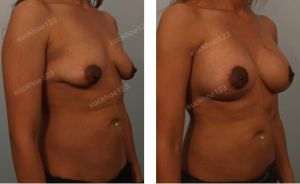 Treo ngực sa trễ kết hợp đặt túi Sientra size 380 cc, nữ 32 tuổi - ca 7