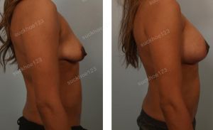 Treo ngực sa trễ kết hợp đặt túi Sientra size 380 cc, nữ 32 tuổi - ca 7