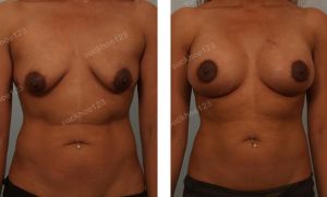 Treo ngực sa trễ kết hợp đặt túi Sientra size 380 cc, nữ 32 tuổi - ca 7