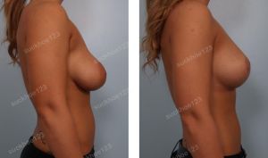 Treo ngực sa trễ kết hợp thay thế túi độn, nữ 24 tuổi - ca 8