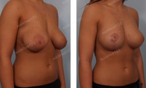 Treo ngực sa trễ kết hợp thay thế túi độn, nữ 24 tuổi - ca 8