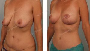 Treo sa trễ kết hợp tiêm mỡ vào cực trên ngực, nữ 46 tuổi - ca 31
