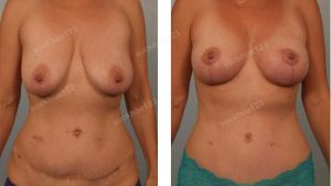 Treo sa trễ kết hợp tiêm mỡ vào cực trên ngực, nữ 46 tuổi - ca 31