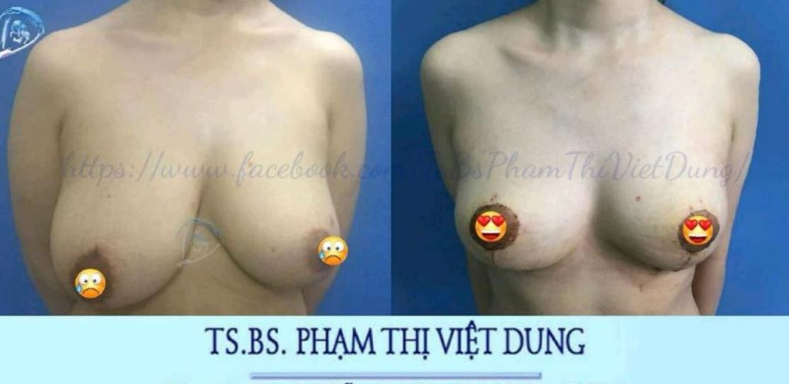 Treo ngực sa trễ - Bs Phạm Thị Việt Dung ca 2