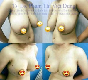 Thu nhỏ ngực phì đại - bs phạm thị việt dung ca 4