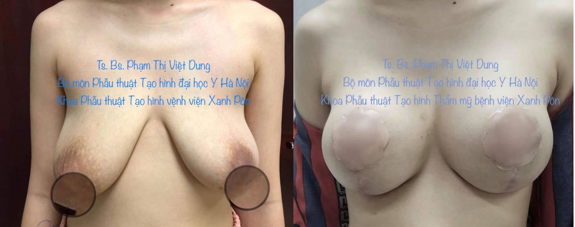 Treo ngực sa trễ - Bs Phạm Thị Việt Dung ca 5