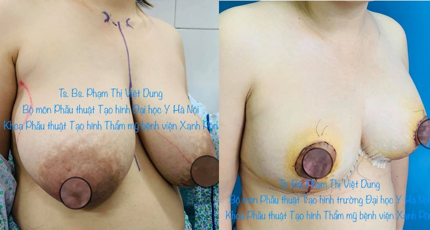 Thu nhỏ ngực phì đại - bs phạm thị việt dung ca 6