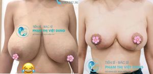 Thu nhỏ ngực phì đại - bs phạm thị việt dung ca 8