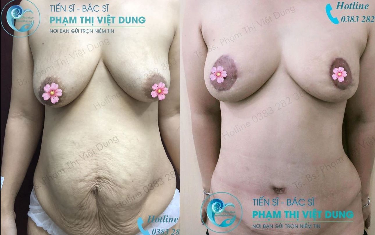 Combo treo ngực sa trễ & tạo hình thành bụng - bs phạm thị việt dung ca 9