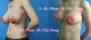 Thu nhỏ ngực phì đại - bs phạm thị việt dung ca 3