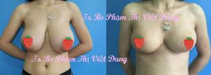 Thu nhỏ ngực phì đại - bs phạm thị việt dung ca 3