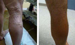 Trị suy giãn tĩnh mạch chân - ca 10