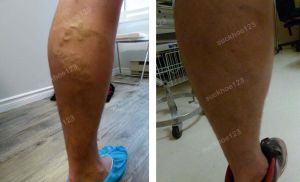 Trị suy giãn tĩnh mạch chân - ca 11