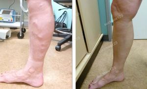 Trị suy giãn tĩnh mạch chân - ca 12