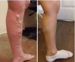 Trị suy giãn tĩnh mạch chân - ca 13