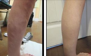 Trị suy giãn tĩnh mạch chân - ca 14