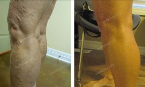 Trị suy giãn tĩnh mạch chân - ca 15