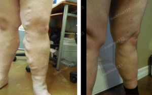 Trị suy giãn tĩnh mạch chân - ca 16