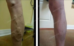 Trị suy giãn tĩnh mạch chân - ca 17