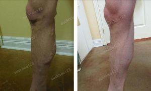 Trị suy giãn tĩnh mạch chân - ca 17