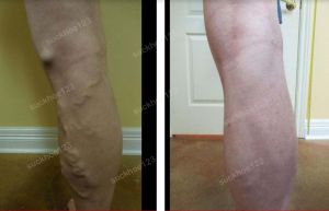 Trị suy giãn tĩnh mạch chân - ca 17