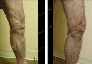 Trị suy giãn tĩnh mạch chân - ca 18