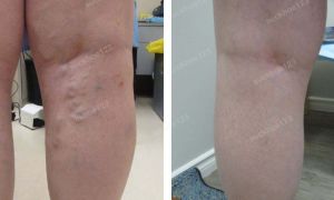 Trị suy giãn tĩnh mạch chân - ca 2