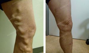 Trị suy giãn tĩnh mạch chân - ca 3