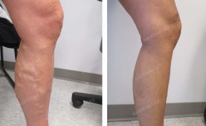 Trị suy giãn tĩnh mạch chân - ca 4