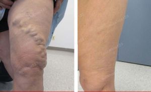 Trị suy giãn tĩnh mạch chân - ca 5