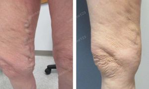 Trị suy giãn tĩnh mạch chân - ca 6