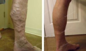 Trị suy giãn tĩnh mạch chân - ca 7