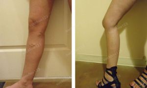 Trị suy giãn tĩnh mạch chân - ca 9