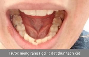 Hình ảnh niềng răng - Bác sĩ Phạm Sơn - Ca 01
