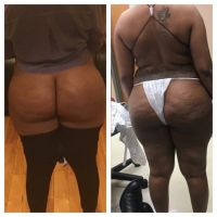 Khối hoại tử mỡ lớn sau cấy mỡ mông Khối hoại tử mỡ lớn sau cấy mỡ mông