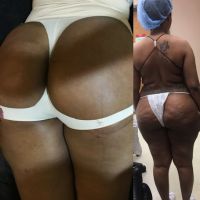 Khối hoại tử mỡ lớn sau cấy mỡ mông