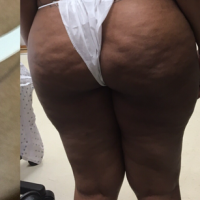 Khối hoại tử mỡ lớn sau cấy mỡ mông