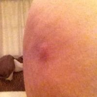 Xử lý hoại tử mỡ sau BBL nhưng để lại lỗ hở trên mông