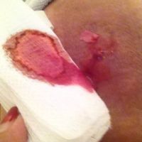 Xử lý hoại tử mỡ sau BBL nhưng để lại lỗ hở trên mông