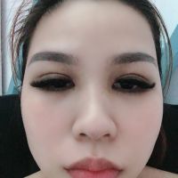Cắt mí