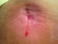 Xử lý hoại tử mỡ sau BBL nhưng để lại lỗ hở trên mông