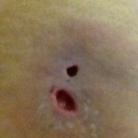 Xử lý hoại tử mỡ sau BBL nhưng để lại lỗ hở trên mông